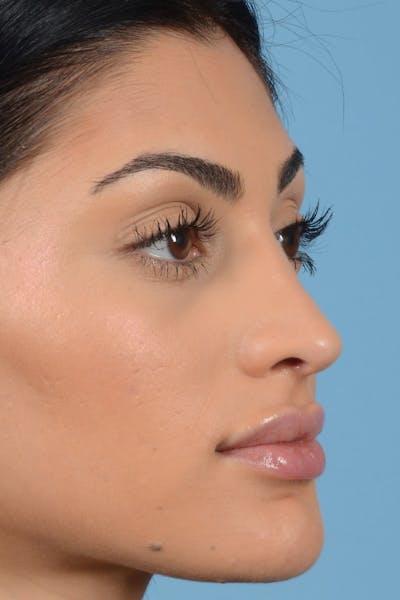 Rhinoplasty Before & After Gallery - Patient 20909783 - Image 2