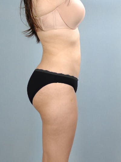 Liposuction Before & After Gallery - Patient 20909779 - Image 2
