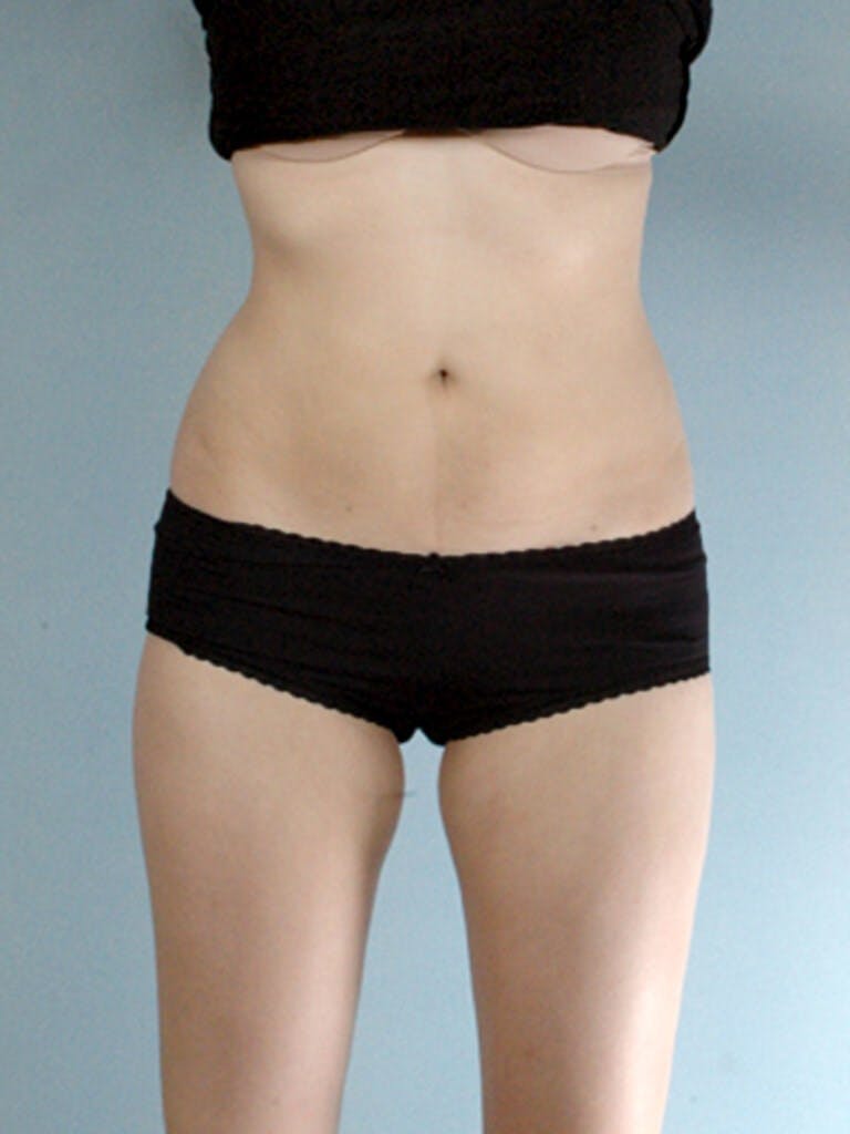 Liposuction Before & After Gallery - Patient 20909779 - Image 3