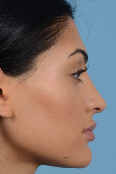 Rhinoplasty Before & After Gallery - Patient 20909783 - Image 6
