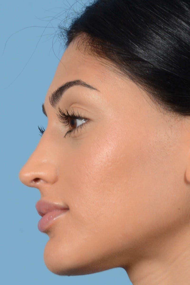 Rhinoplasty Before & After Gallery - Patient 20909783 - Image 8