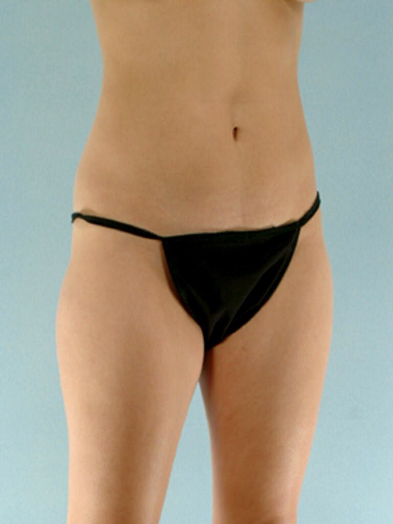 Liposuction Before & After Gallery - Patient 20909784 - Image 5