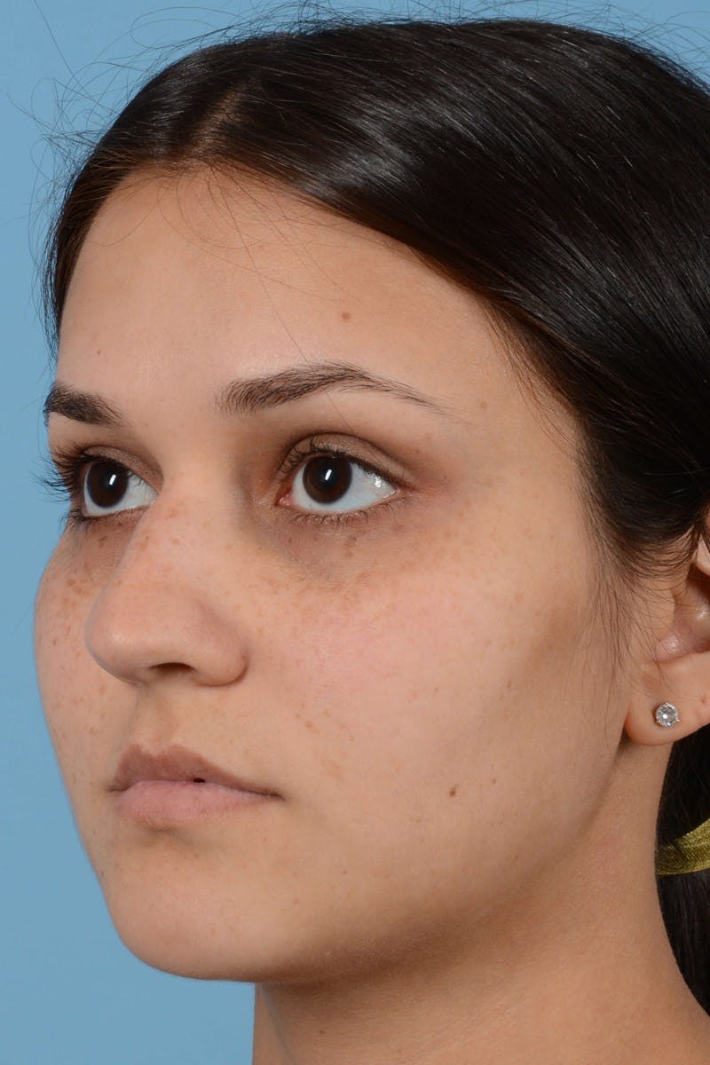 Rhinoplasty Before & After Gallery - Patient 20909786 - Image 1