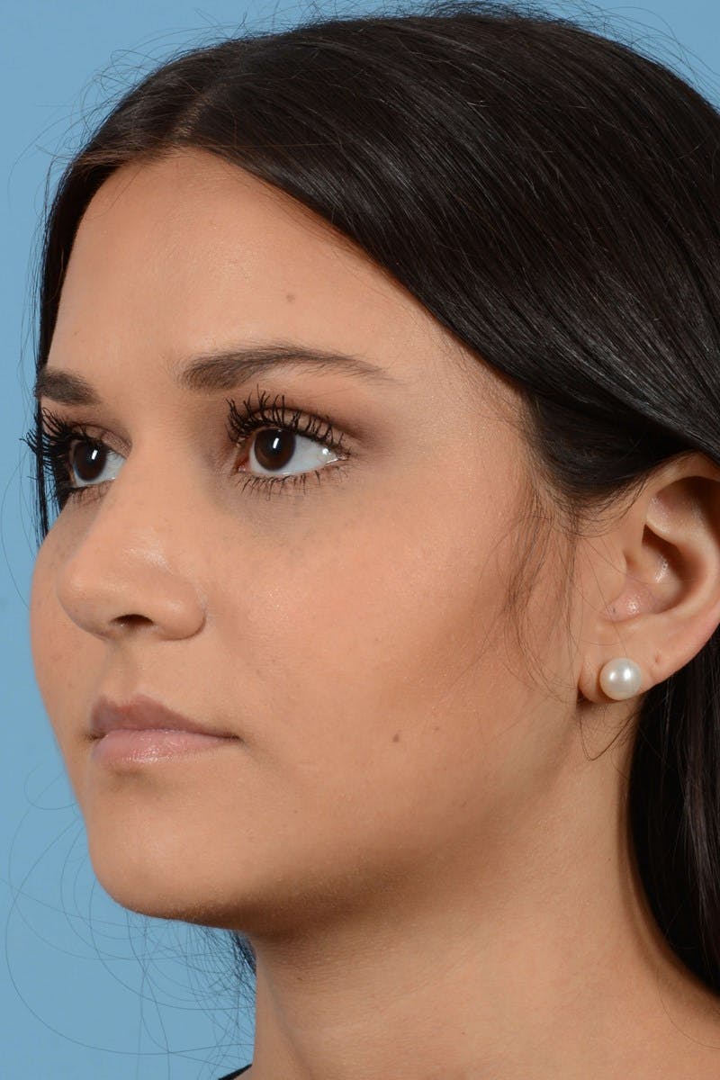 Rhinoplasty Before & After Gallery - Patient 20909786 - Image 2