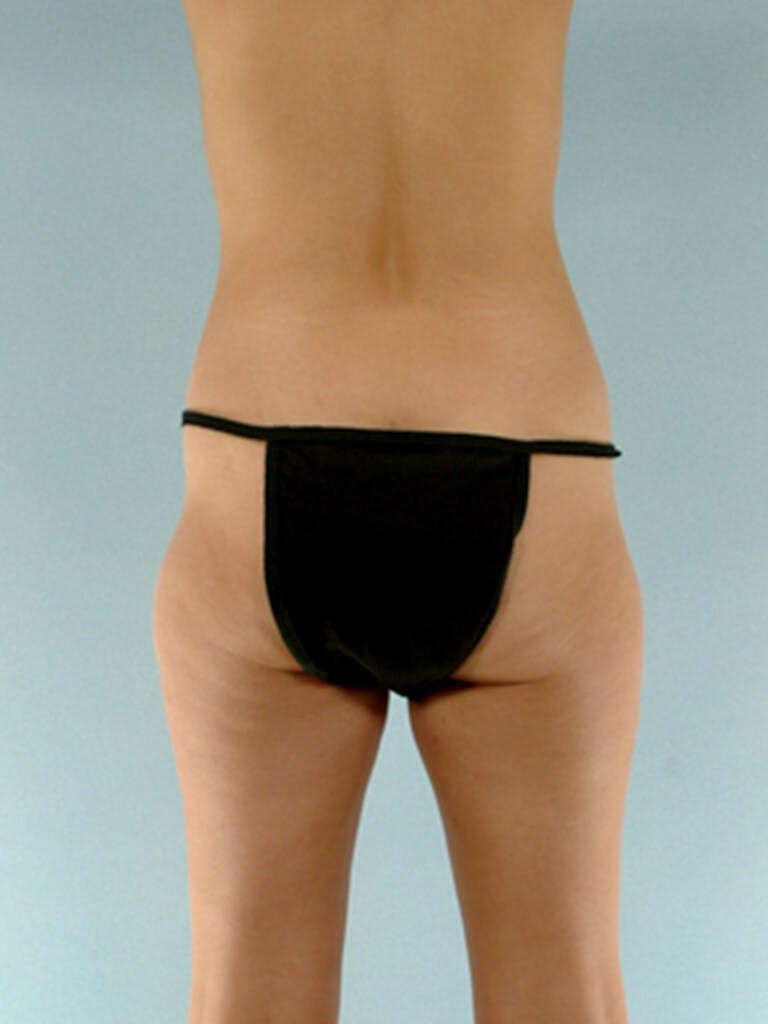 Liposuction Before & After Gallery - Patient 20909784 - Image 7