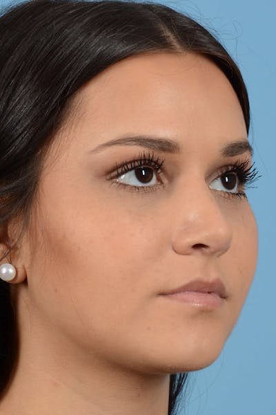 Rhinoplasty Before & After Gallery - Patient 20909786 - Image 4