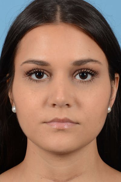 Rhinoplasty Before & After Gallery - Patient 20909786 - Image 6