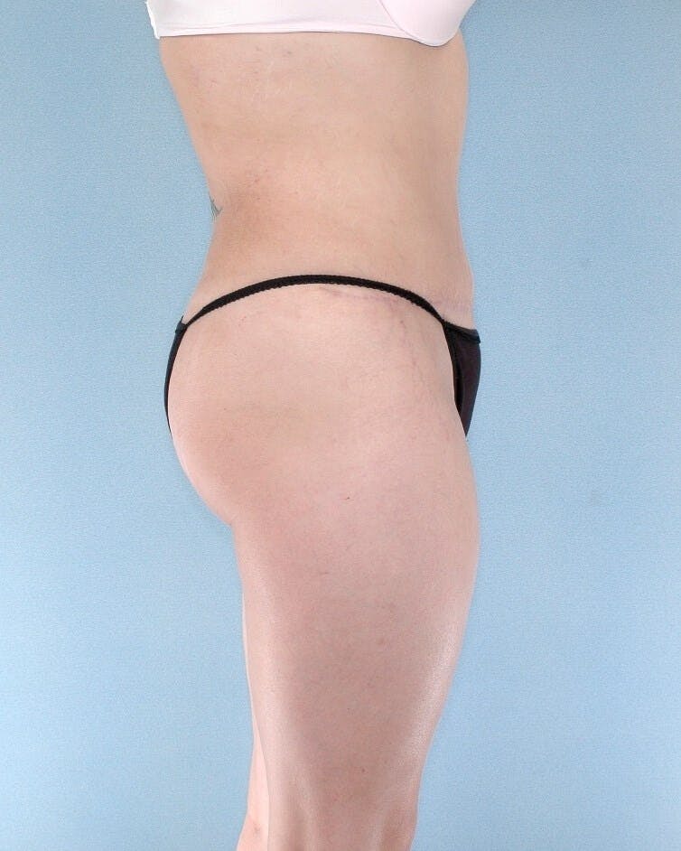 Liposuction Gallery - Patient 20909787 - Image 4