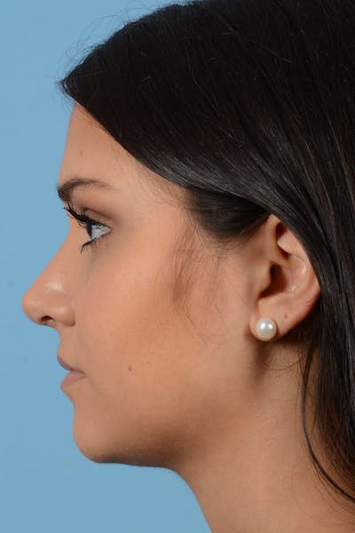 Rhinoplasty Before & After Gallery - Patient 20909786 - Image 8