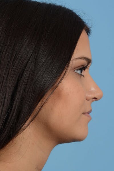 Rhinoplasty Before & After Gallery - Patient 20909786 - Image 10