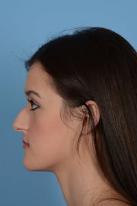 Rhinoplasty Before & After Gallery - Patient 20909797 - Image 1