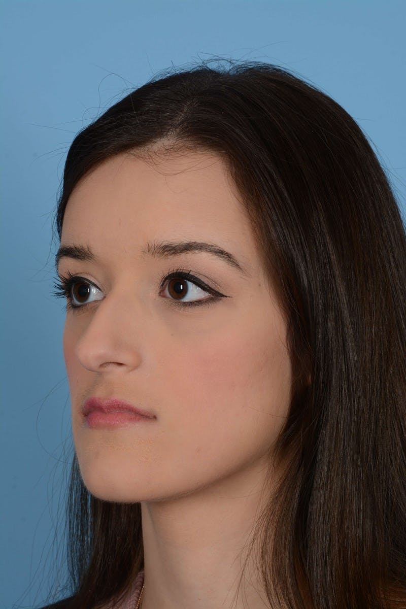 Rhinoplasty Before & After Gallery - Patient 20909797 - Image 3