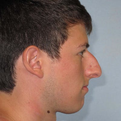 Rhinoplasty Before & After Gallery - Patient 20909800 - Image 1