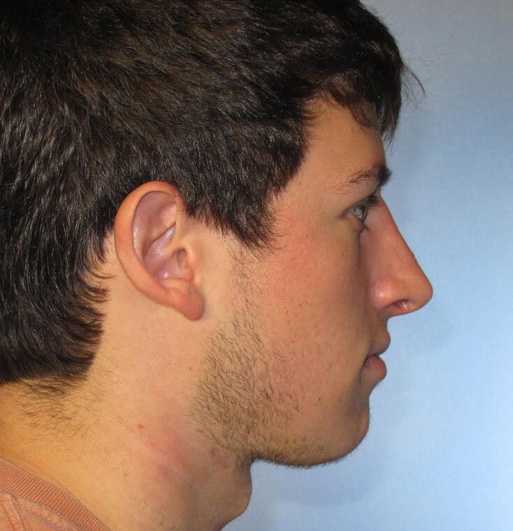 Rhinoplasty Before & After Gallery - Patient 20909800 - Image 2