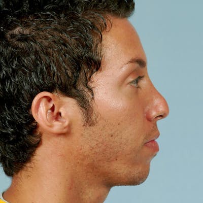 Rhinoplasty Before & After Gallery - Patient 20909804 - Image 1