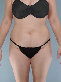 Liposuction Before & After Gallery - Patient 20909805 - Image 1