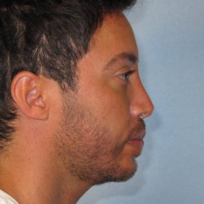 Rhinoplasty Before & After Gallery - Patient 20909804 - Image 2
