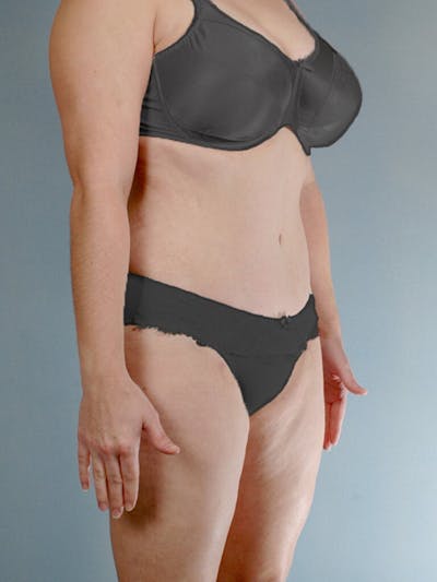 Liposuction Before & After Gallery - Patient 20909805 - Image 4