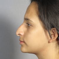 Rhinoplasty Before & After Gallery - Patient 20909806 - Image 1
