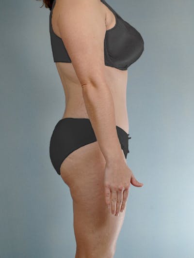 Liposuction Before & After Gallery - Patient 20909805 - Image 6