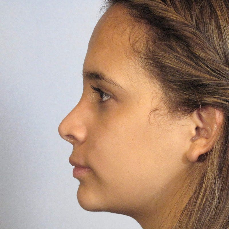 Rhinoplasty Before & After Gallery - Patient 20909806 - Image 2
