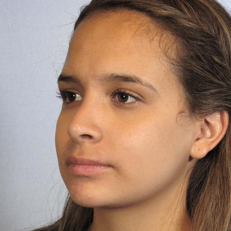 Rhinoplasty Before & After Gallery - Patient 20909806 - Image 4