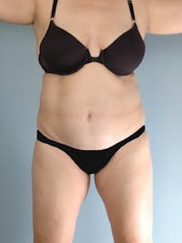 Liposuction Before & After Gallery - Patient 20909813 - Image 1
