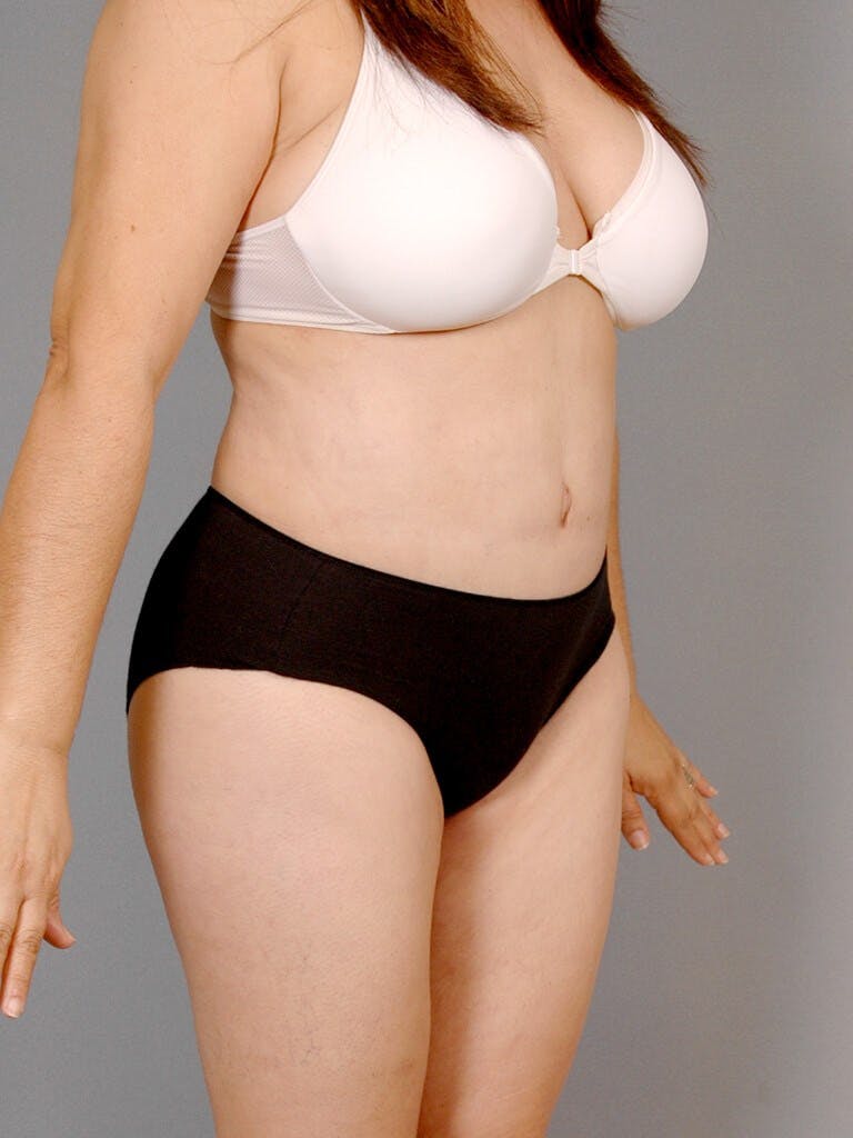 Liposuction Before & After Gallery - Patient 20909813 - Image 4