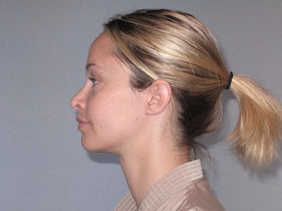 Rhinoplasty Before & After Gallery - Patient 20909815 - Image 2