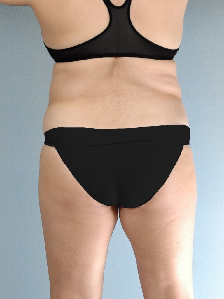 Liposuction Before & After Gallery - Patient 20909813 - Image 7