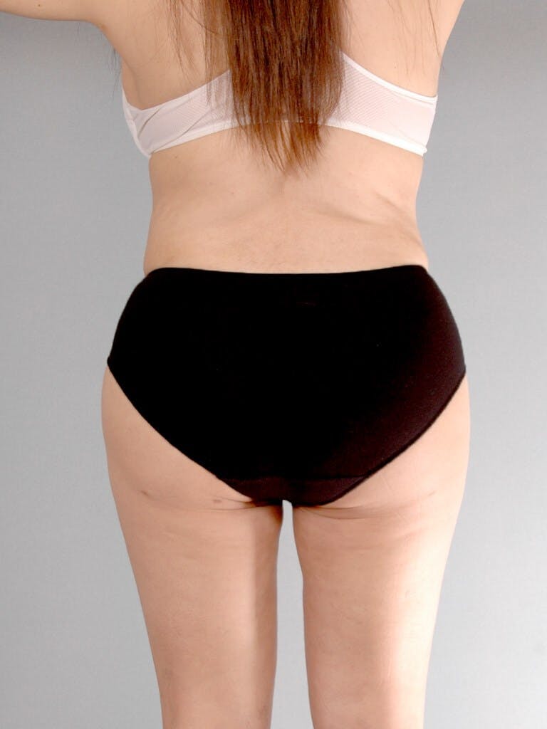 Liposuction Before & After Gallery - Patient 20909813 - Image 8