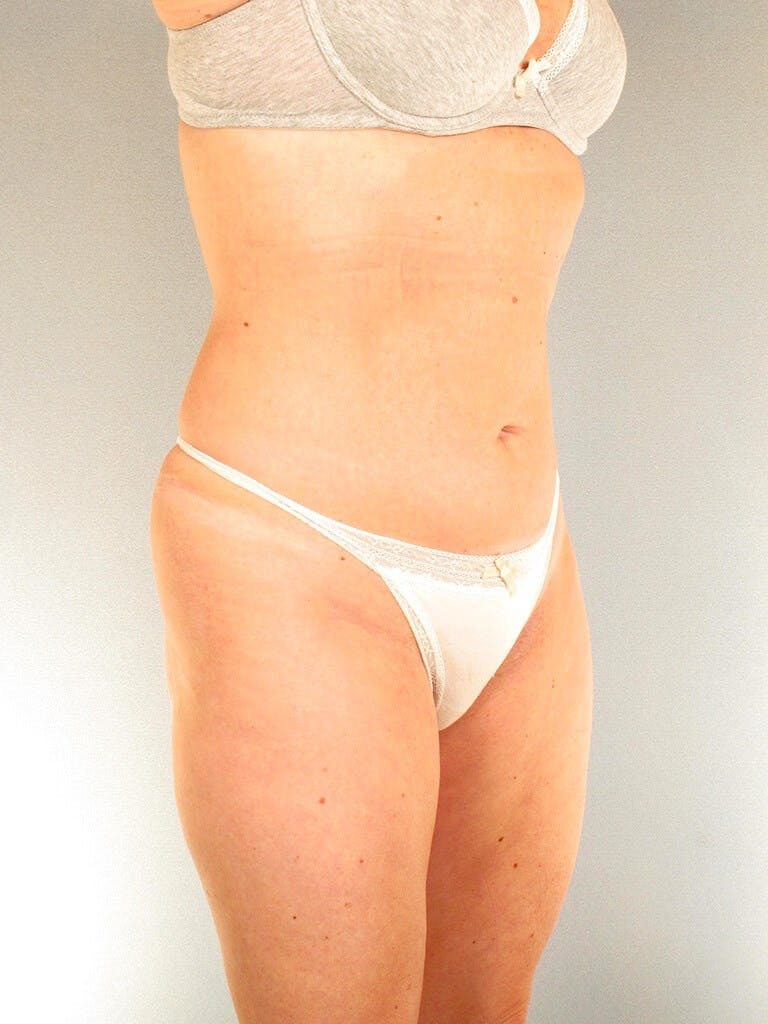 Liposuction Before & After Gallery - Patient 20909816 - Image 5