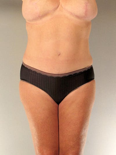 Tummy Tuck Before & After Gallery - Patient 20909819 - Image 2