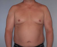 Liposuction Before & After Gallery - Patient 20909820 - Image 1