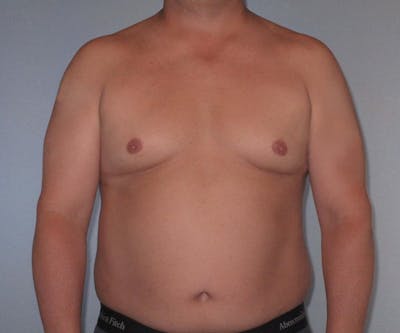 Liposuction Gallery - Patient 20909820 - Image 1