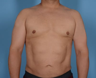 Liposuction Before & After Gallery - Patient 20909820 - Image 2