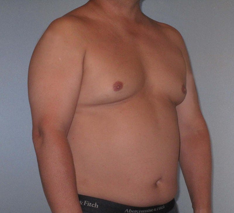 Liposuction Before & After Gallery - Patient 20909820 - Image 3