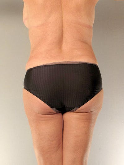 Tummy Tuck Before & After Gallery - Patient 20909819 - Image 8