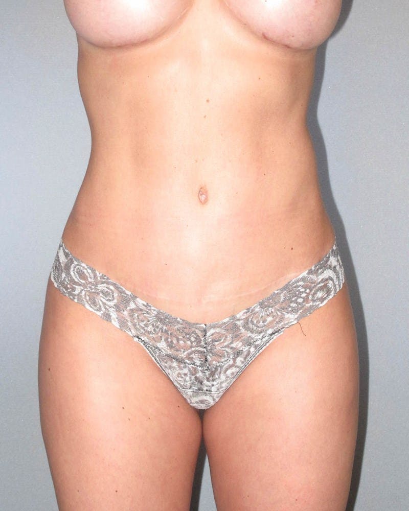 Tummy Tuck Before & After Gallery - Patient 20909821 - Image 2