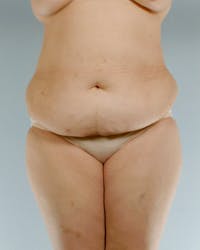 Tummy Tuck Before & After Gallery - Patient 20909824 - Image 1