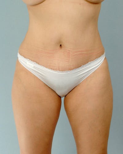 Tummy Tuck Before & After Gallery - Patient 20909824 - Image 2