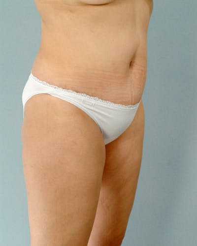 Tummy Tuck Before & After Gallery - Patient 20909824 - Image 4