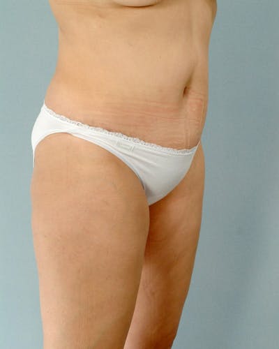 Tummy Tuck Gallery - Patient 20909824 - Image 4