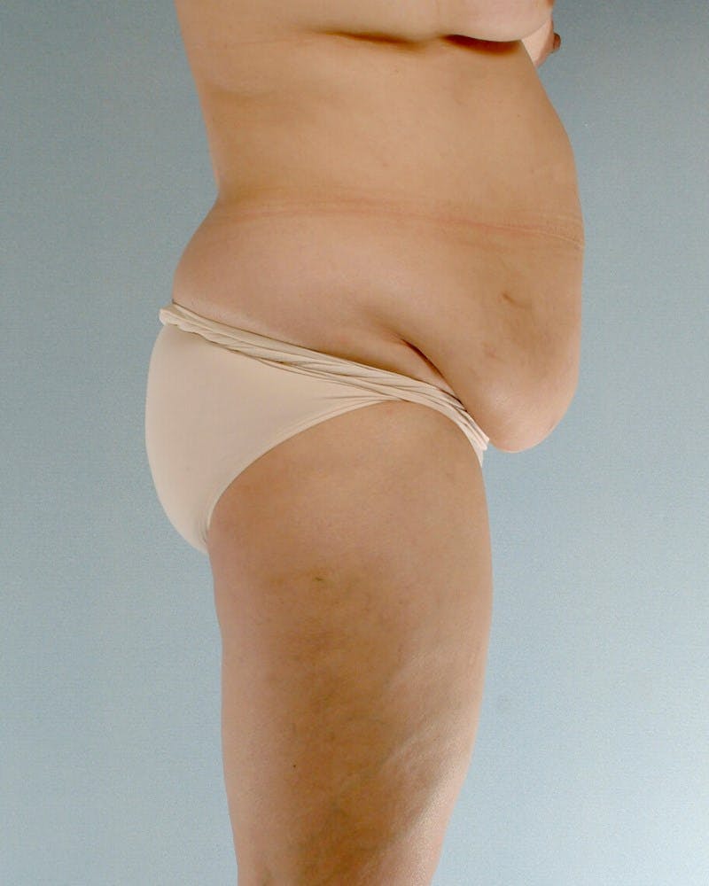 Tummy Tuck Before & After Gallery - Patient 20909824 - Image 5