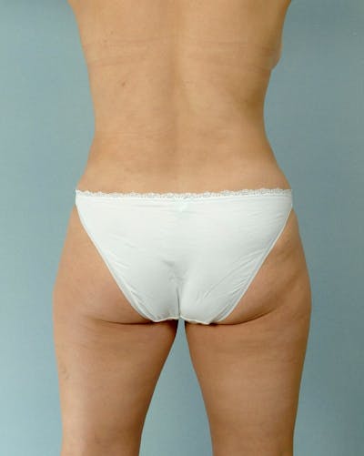 Tummy Tuck Before & After Gallery - Patient 20909824 - Image 8