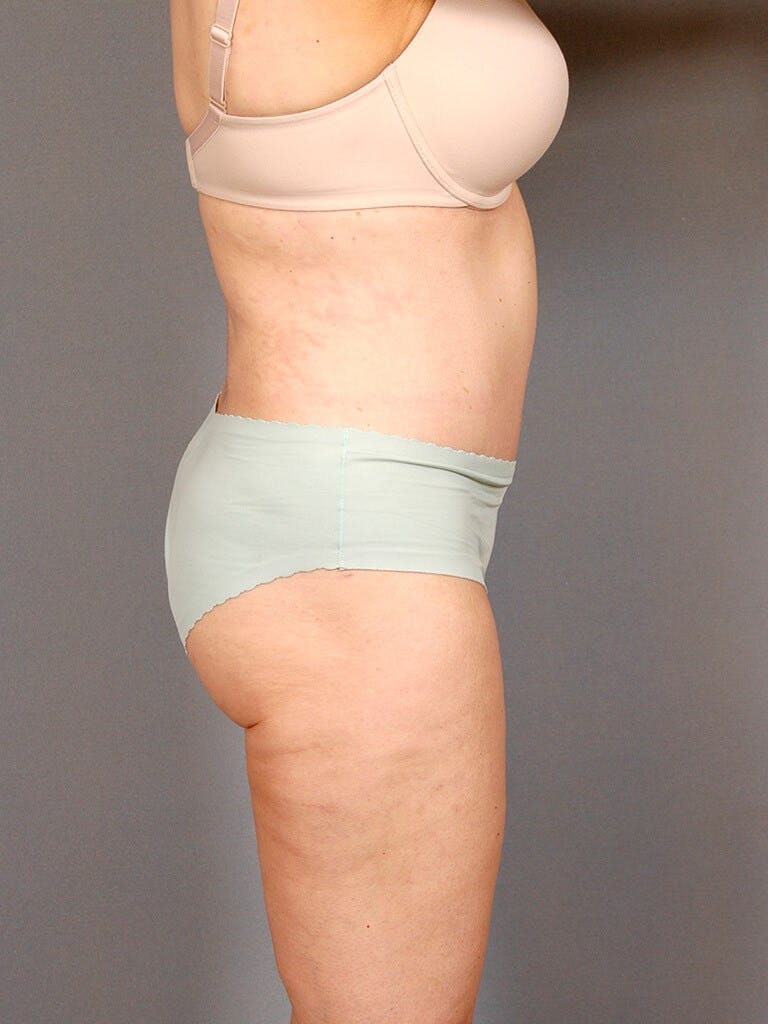 Tummy Tuck Before & After Gallery - Patient 20909830 - Image 6