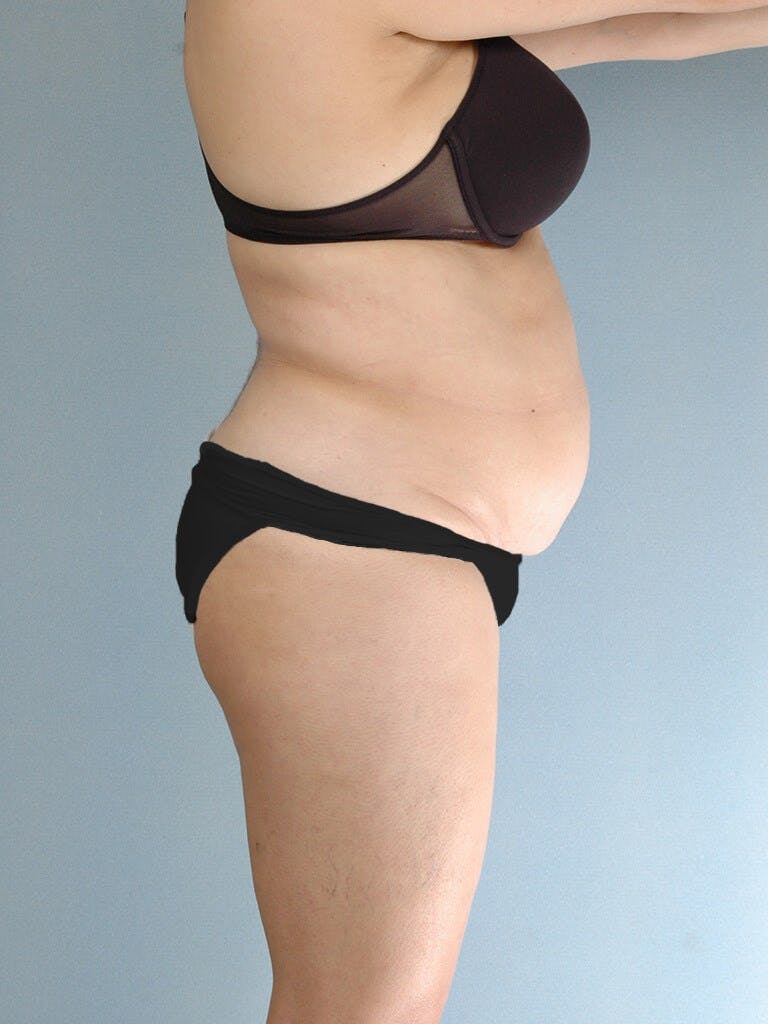 Tummy Tuck Before & After Gallery - Patient 20909834 - Image 5