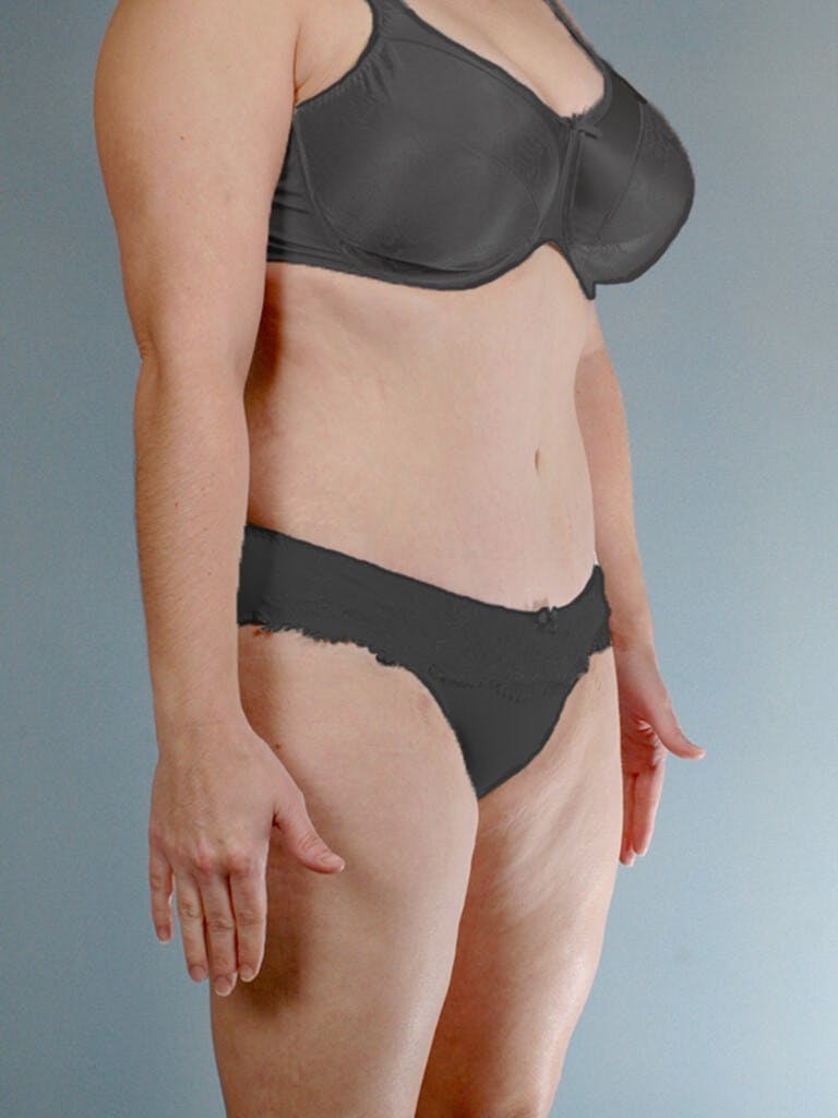 Tummy Tuck Before & After Gallery - Patient 20909843 - Image 4