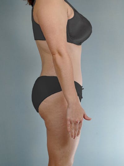 Tummy Tuck Before & After Gallery - Patient 20909843 - Image 6