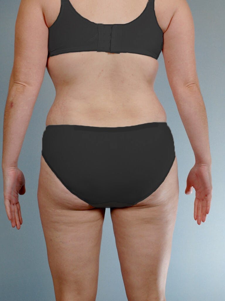 Tummy Tuck Before & After Gallery - Patient 20909843 - Image 8